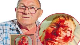 Drago? Panaitescu, olimpicul român c?ruia medicii i-au reconstruit fa?a, dup? ce a suferit un grav accident la bob:&nbsp;(…)