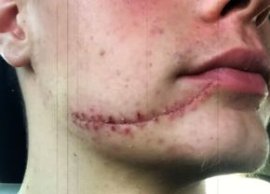 „Scarface” de la Jocurile Olimpice: are o cicatrice mare pe fa?? ?i doi din?i de aur » „Era ca o sabie de samurai”